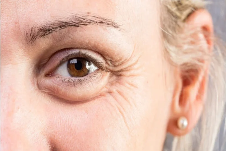 Botox for Crow’s Feet at serenity clinic