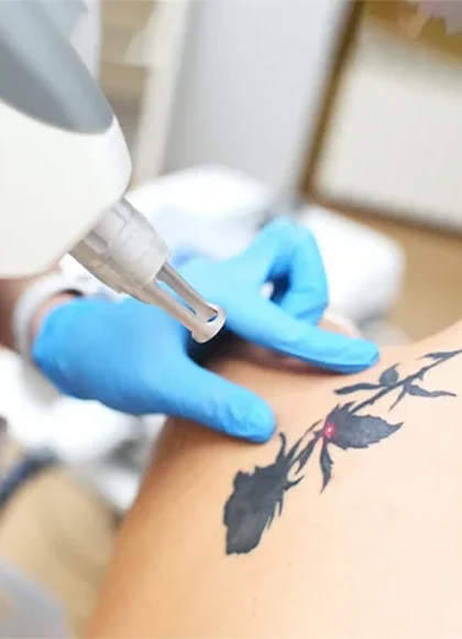Laser Tattoo Removal