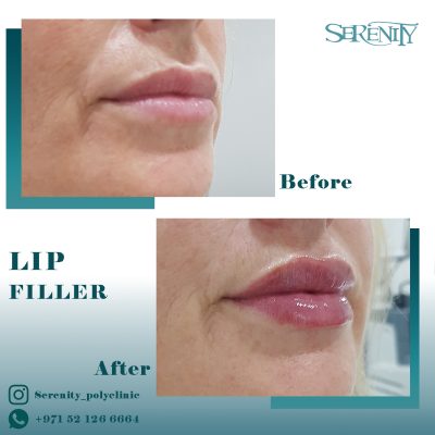 LIP FILLER B-F